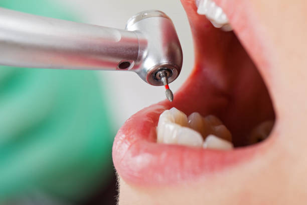 Best Dental Abscess Treatment in Indian Springs Village, AL